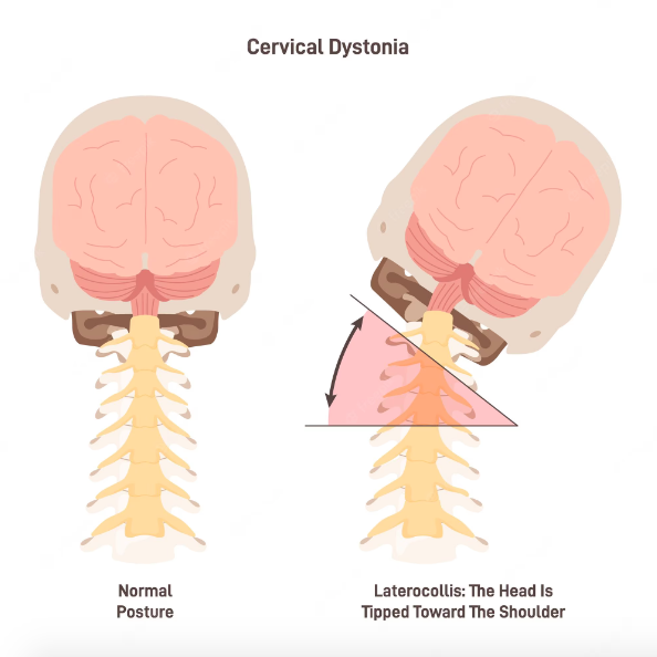 Descubriendo la Distonía Cervical: Una enfermedad que puede dejar sin habla por años 1 Captura de Pantalla 2023 06 21 a las 10.24.30 a. m